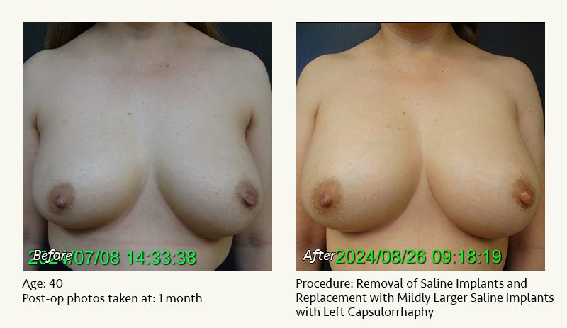 Breast Implant Revision in Plano, TX - Patient 35