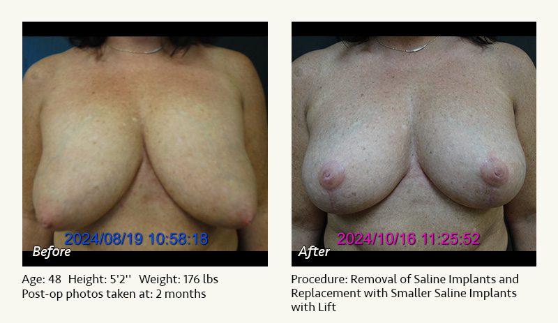 Breast Implant Revision in Plano, TX - Patient 33