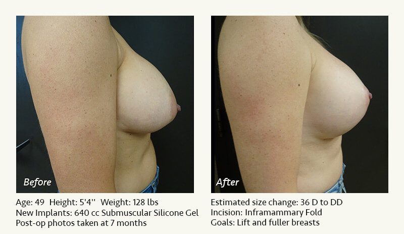 Breast Implant Revision in Plano, TX - Patient 60
