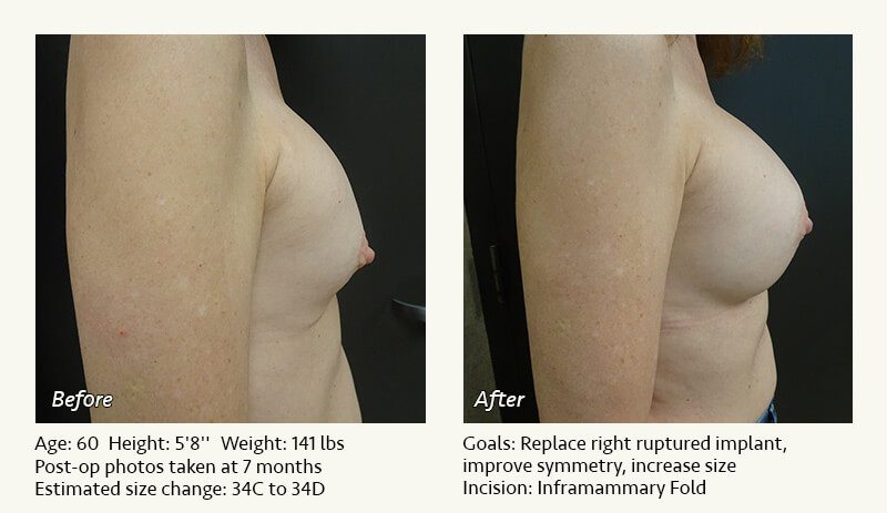 Breast Implant Revision in Plano, TX - Patient 64