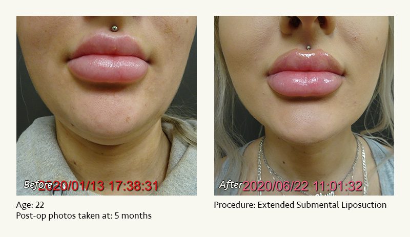Chin Liposuction in Plano, TX - Patient 47
