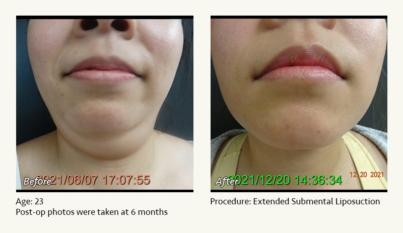 Chin Liposuction in Plano, TX - Patient 45