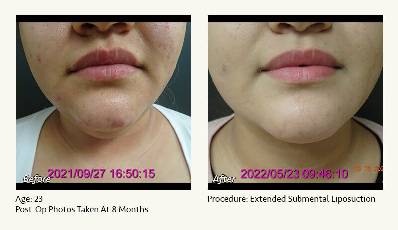 Chin Liposuction in Plano, TX - Patient 41