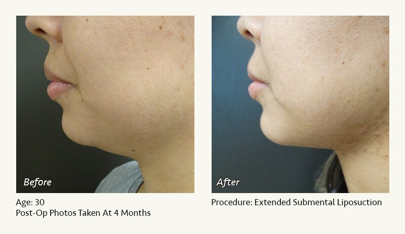 Chin Liposuction in Plano, TX - Patient 40