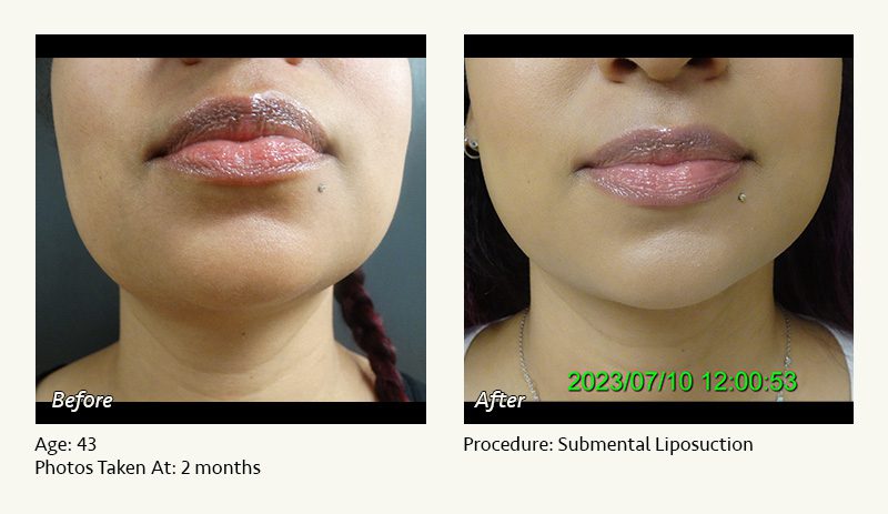 Chin Liposuction in Plano, TX - Patient 35
