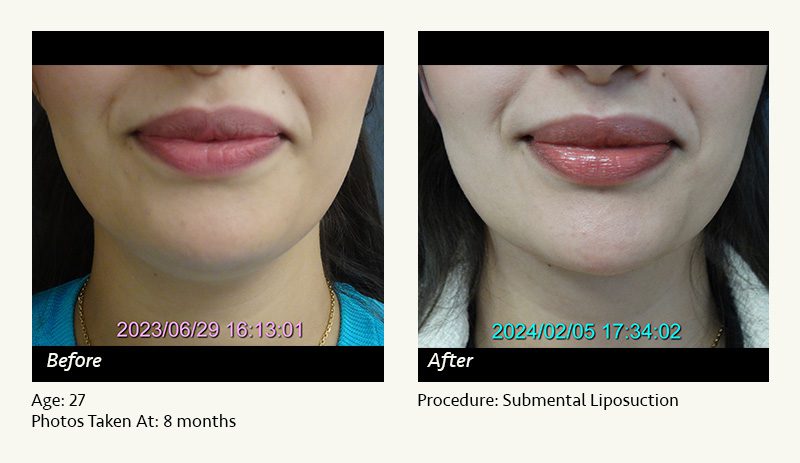 Chin Liposuction in Plano, TX - Patient 31