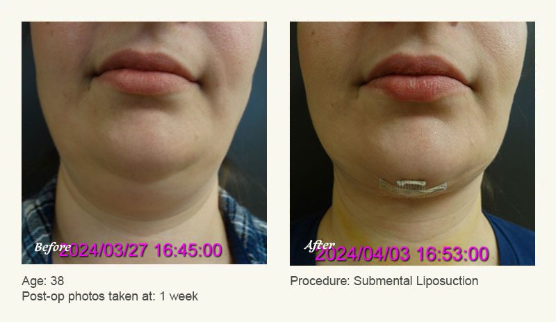 Chin Liposuction in Plano, TX - Patient 25