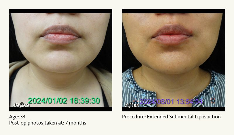 Chin Liposuction in Plano, TX - Patient 21