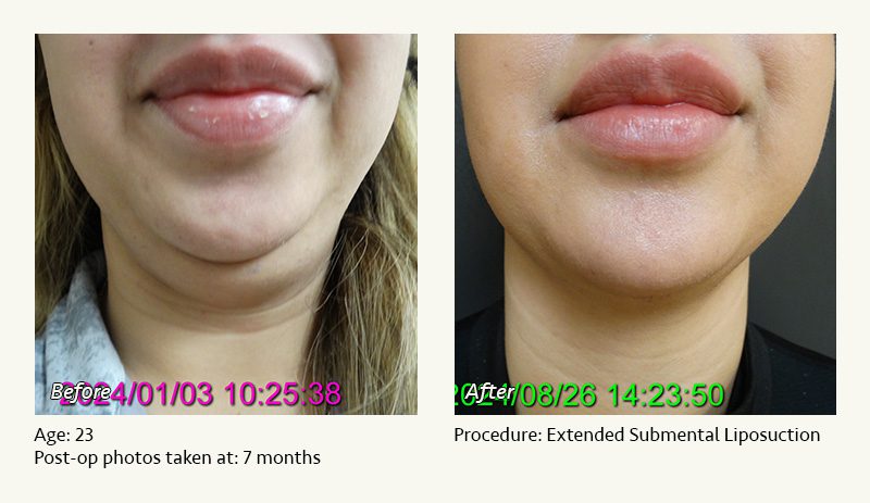 Chin Liposuction in Plano, TX - Patient 19