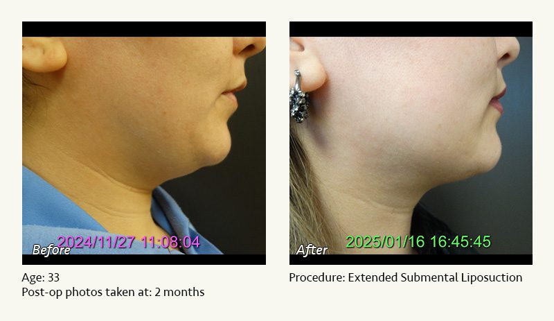 Chin Liposuction in Plano, TX - Patient 18