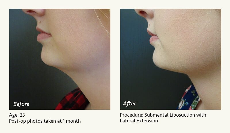 Chin Liposuction in Plano, TX - Patient 54