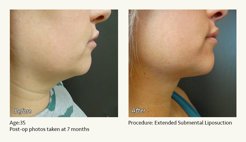 Chin Liposuction in Plano, TX - Patient 98