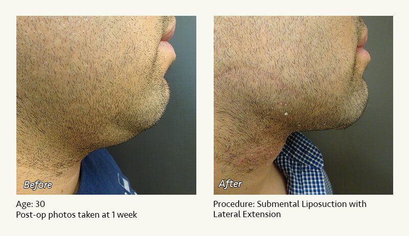 Chin Liposuction in Plano, TX - Patient 56