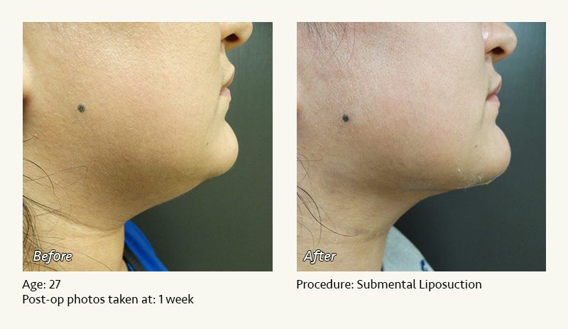 Chin Liposuction in Plano, TX - Patient 28