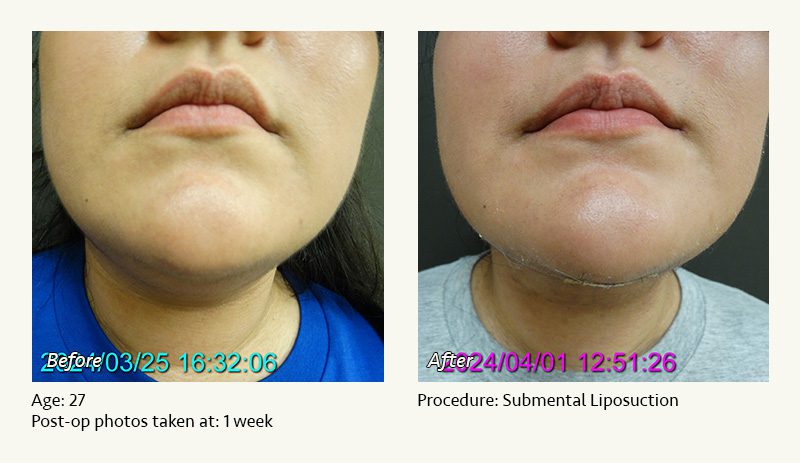 Chin Liposuction in Plano, TX - Patient 27