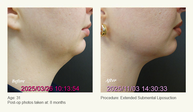 Chin Liposuction in Plano, TX - Patient 8