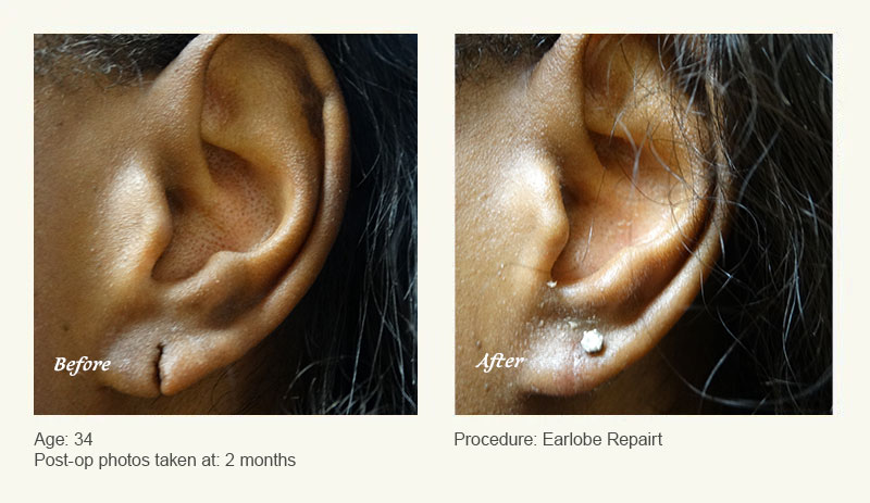 Earlobe Surgery in Plano, TX - Patient 11