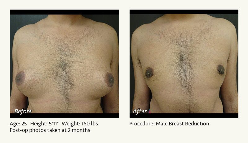 Male Breast Reduction Surgery in Plano, TX - Patient 17