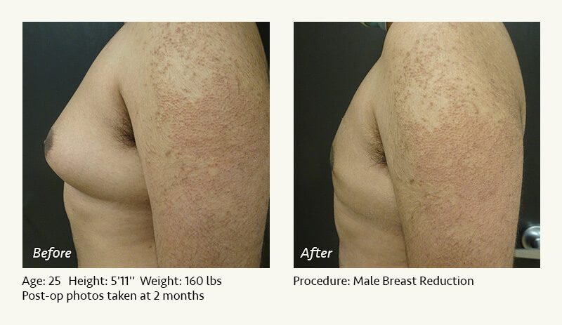 Male Breast Reduction Surgery in Plano, TX - Patient 18