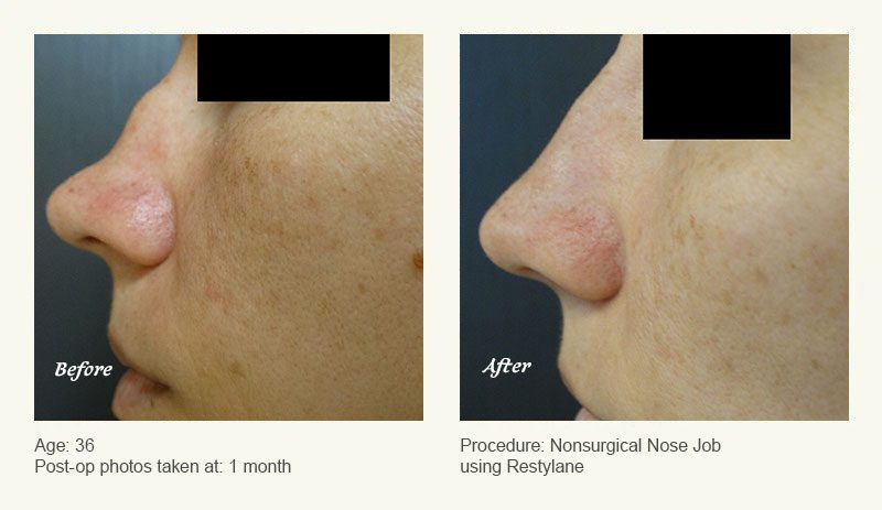Nonsurgical Rhinoplasty in Plano & Dallas, TX - Patient 1