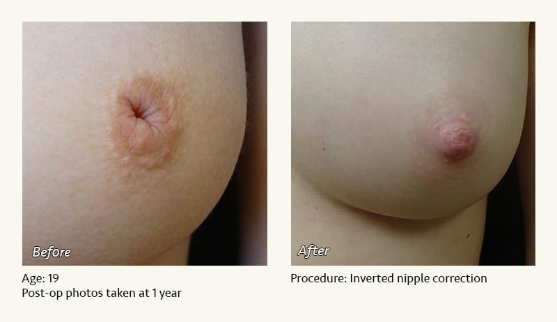 Nipple Procedures (Female) in Plano, TX - Patient 47