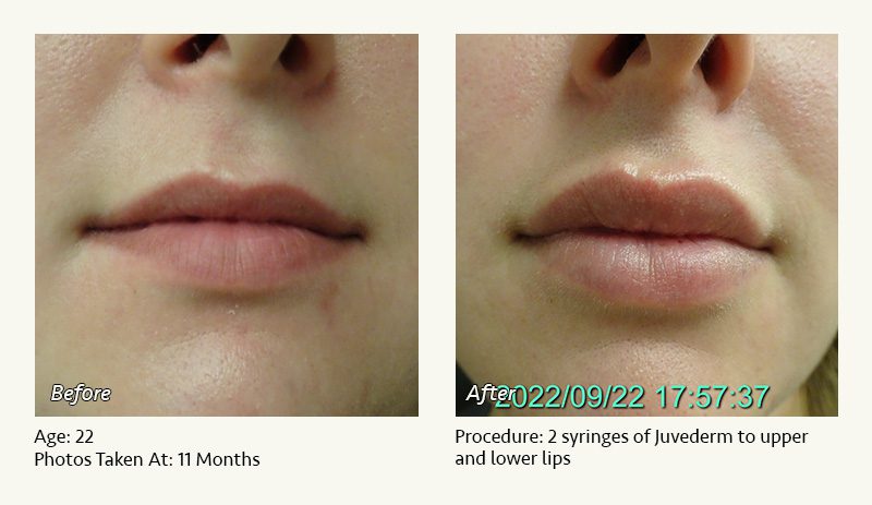 Restylane® & JUVÉDERM® Gel Injectable Fillers In Plano, TX - Patient 14