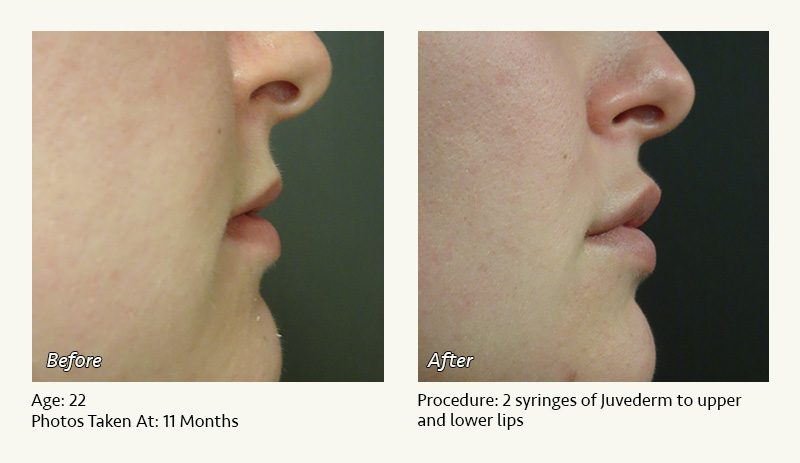 Restylane® & JUVÉDERM® Gel Injectable Fillers In Plano, TX - Patient 15