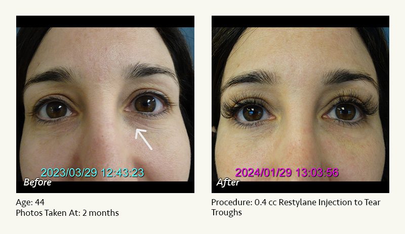 Restylane® & JUVÉDERM® Gel Injectable Fillers In Plano, TX - Patient 10