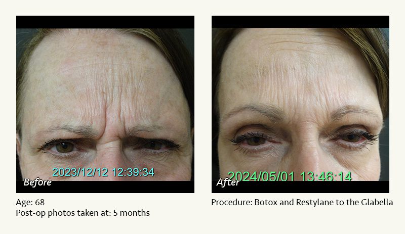 Restylane® & JUVÉDERM® Gel Injectable Fillers In Plano, TX - Patient 7