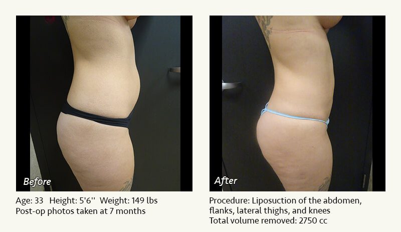 Liposuction Surgery in Dallas & Plano - Patient 20