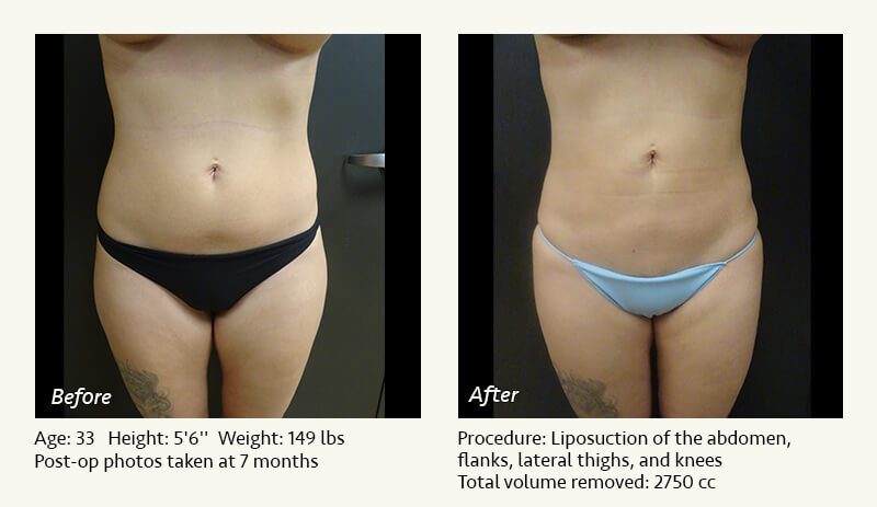 Liposuction Surgery in Dallas & Plano - Patient 19