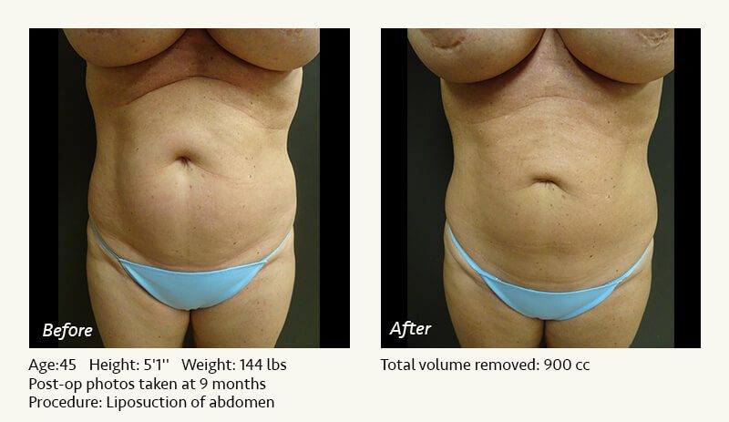 Liposuction Surgery in Dallas & Plano - Patient 17