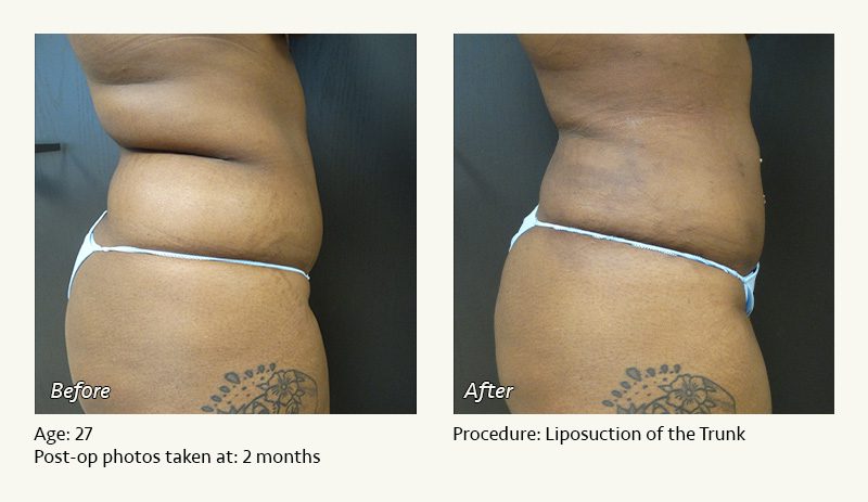 Liposuction Surgery in Dallas & Plano - Patient 12