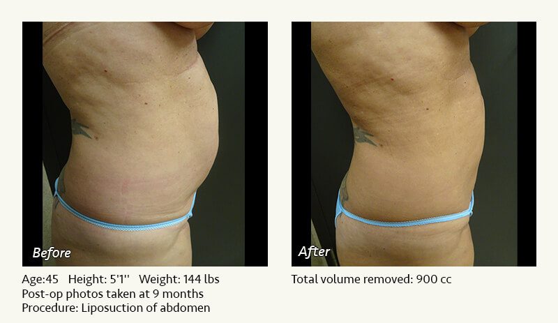 Liposuction Surgery in Dallas & Plano - Patient 18
