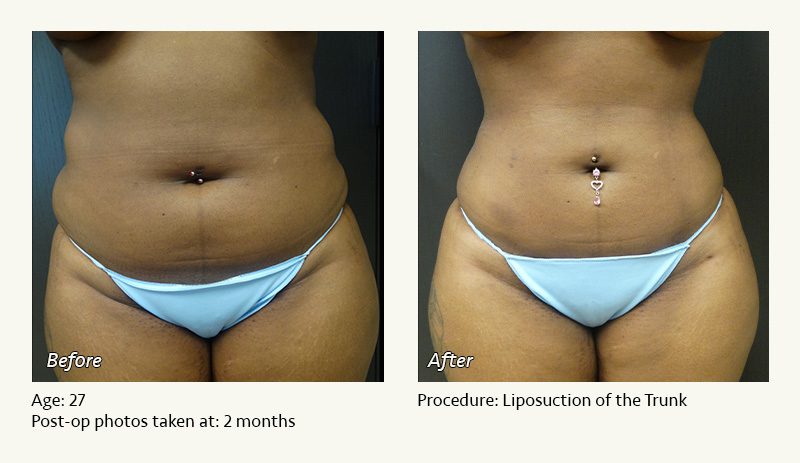 Liposuction Surgery in Dallas & Plano - Patient 11