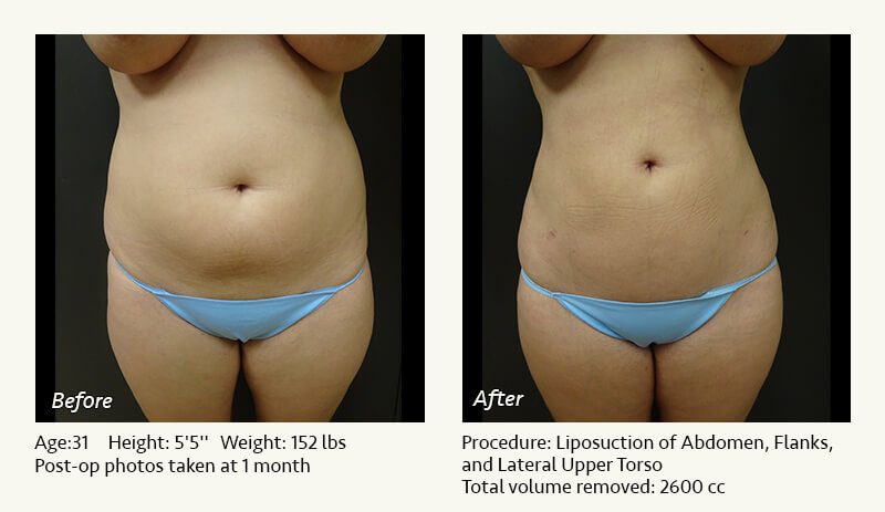 Liposuction Surgery in Dallas & Plano - Patient 15