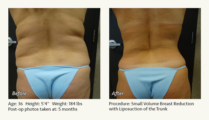 Liposuction Surgery in Dallas & Plano - Patient 10