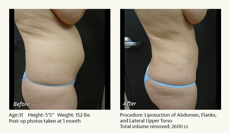 Liposuction Surgery in Dallas & Plano - Patient 16