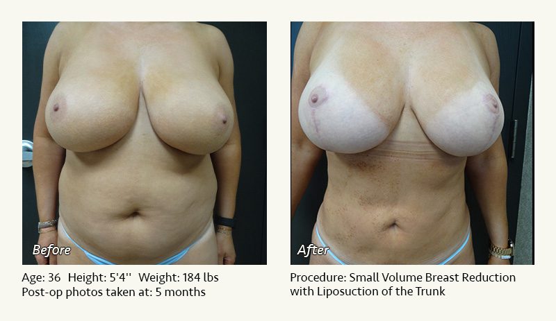 Liposuction Surgery in Dallas & Plano - Patient 9