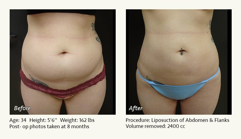 Liposuction Surgery in Dallas & Plano - Patient 13