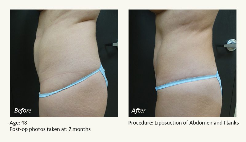 Liposuction Surgery in Dallas & Plano - Patient 8
