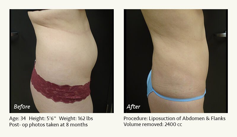 Liposuction Surgery in Dallas & Plano - Patient 14