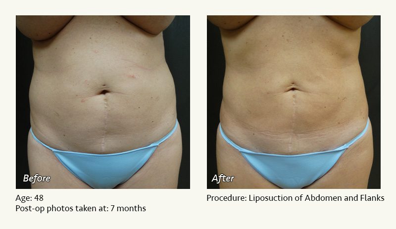 Liposuction Surgery in Dallas & Plano - Patient 7