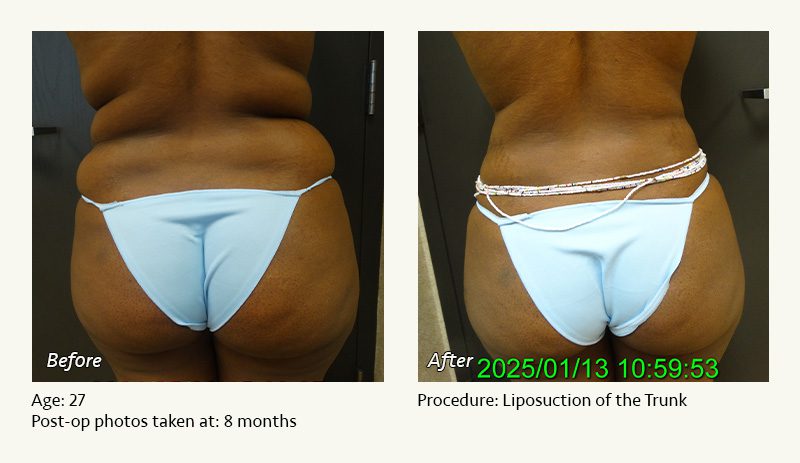 Liposuction Surgery in Dallas & Plano - Patient 6