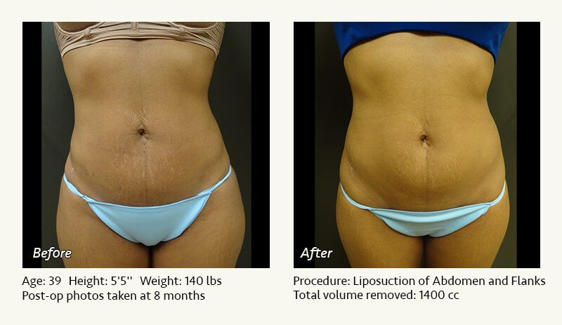 Liposuction Surgery in Dallas & Plano - Patient 21