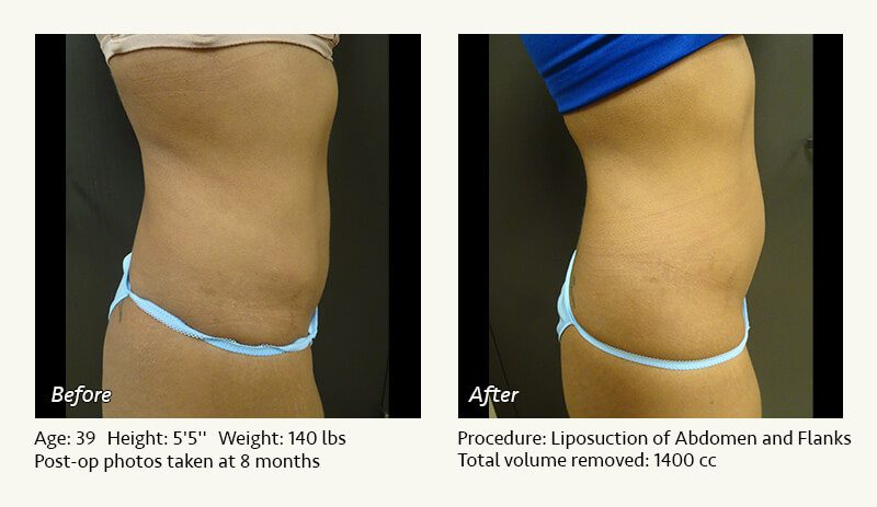 Liposuction Surgery in Dallas & Plano - Patient 22