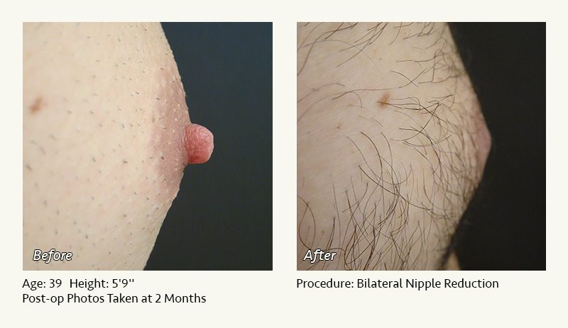 Male Nipple Reduction in Plano, TX - Patient 20