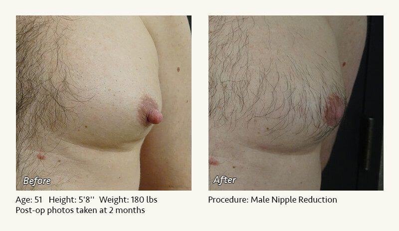 Male Nipple Reduction in Plano, TX - Patient 35