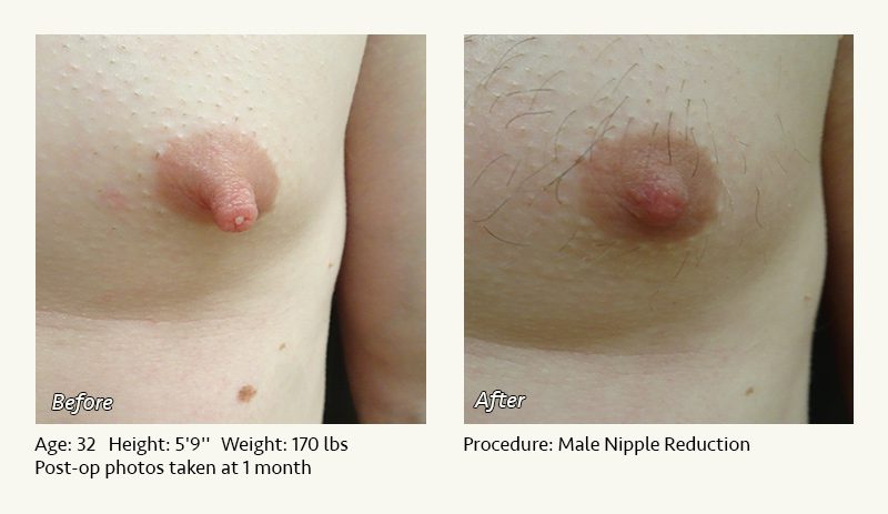 Male Nipple Reduction in Plano, TX - Patient 33