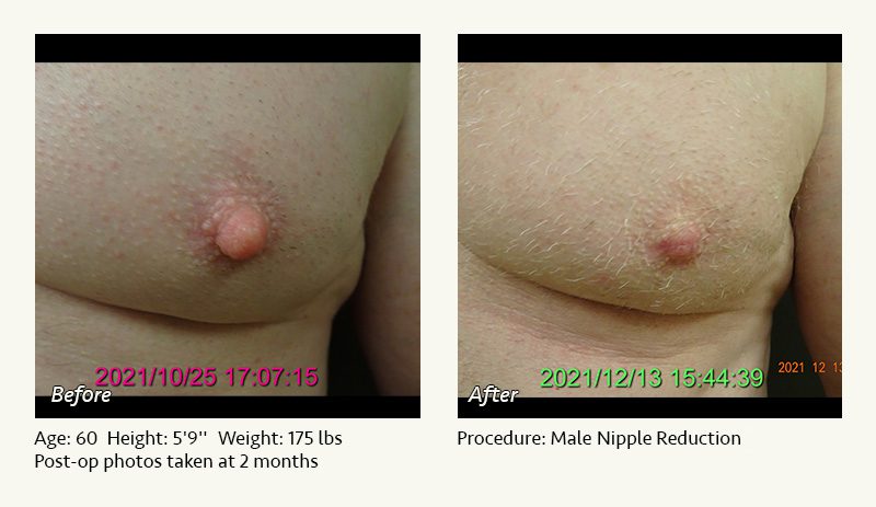 Male Nipple Reduction in Plano, TX - Patient 25